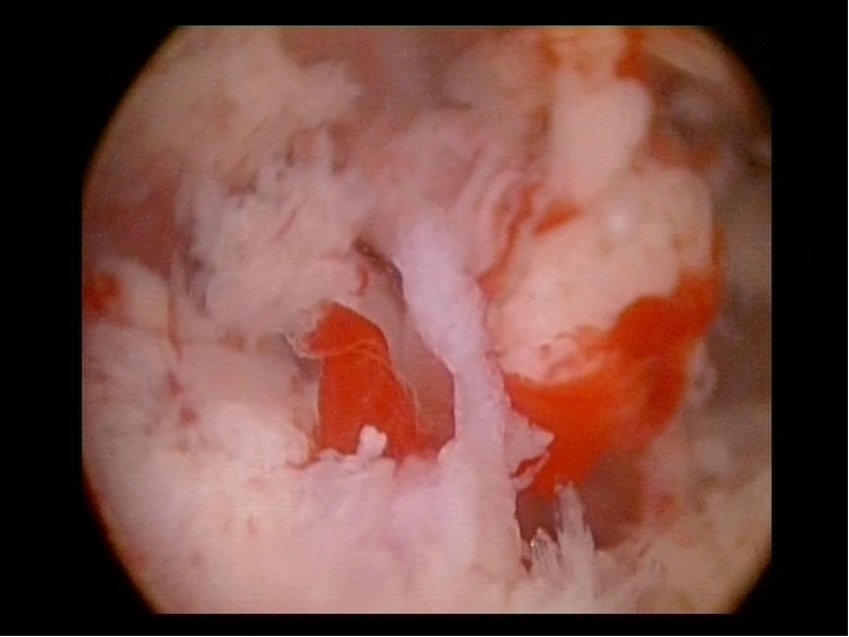 endometrial hyperplasia with polyps